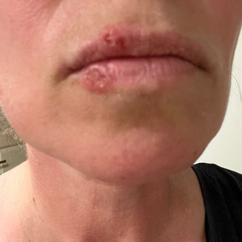 Anna_alkutilanne Anna_alkutilanne