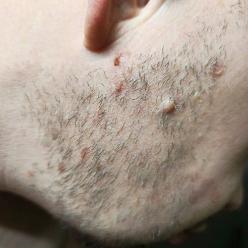 janne_parantuminen2 janne_parantuminen2